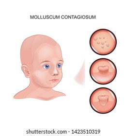 vector illustration of Molluscum contagiosum in a child.