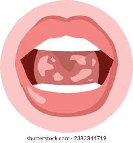 
Vektorgrafik einer Mundschleimhaut, die an einer Candidiasis-Infektion leidet. Offene Buccal-Höhle mit weißem Fungenkrebs 
