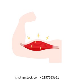 Vector illustration of muscle damage ( after training )