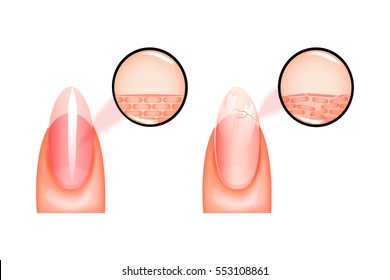 vector illustration of nail, healthy and sick under magnification. for medical and promotional publications