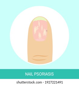 Vector illustration "Nail psoriasis". Circle icon of fingernail with psoriasis. Colorful image for medical articles, posters and banners.