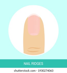 Vector illustration "Nail ridges". Circle icon of fingernail with vertical ridges. Colorful image for medical articles, posters and banners.