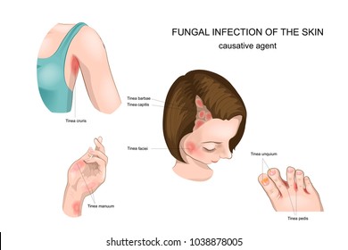 vector illustration of nail,skin and hair fungus
