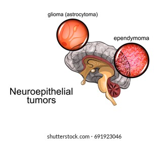 vector illustration of a neuroepithelial brain tumor. histology
