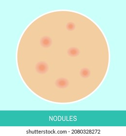 Vector illustration "Nodules". Close up skin image with nodules. Colorful image for medical articles, posters and banners.