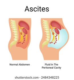 Vector Illustration of Normal Abdominal Ascites and Fluid in Peritoneal Cavity