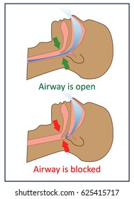 Vector illustration of normal breathing and with apnea symptoms.