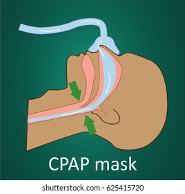 Vector Illustration Of Normal Breathing With CPAP Mask. 