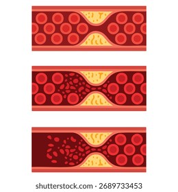 Ilustração vetorial da artéria obstruída normal e pelo colesterol com trombo de coágulo sanguíneo placa aterosclerótica TVP conceito de trombose venosa profunda e fluxo vascular