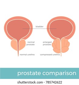 vector illustration of normal and enlarged prostate comparison