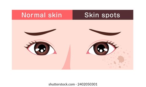 Vector illustration of normal facial skin and facial skin with spots.