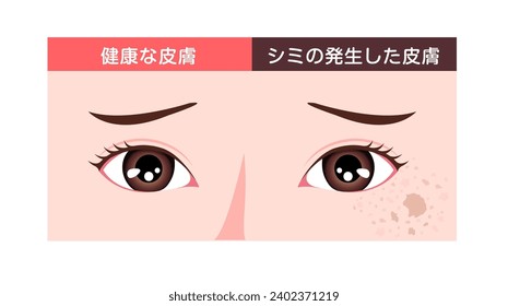 Ilustración vectorial de la piel facial normal y de la piel facial con manchas. Traducción: Piel normal, manchas cutáneas.