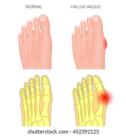 Vector Illustration of the normal foot and hallux valgus. External and skeletal views.  Used: gradient, transparency, Blend mode.