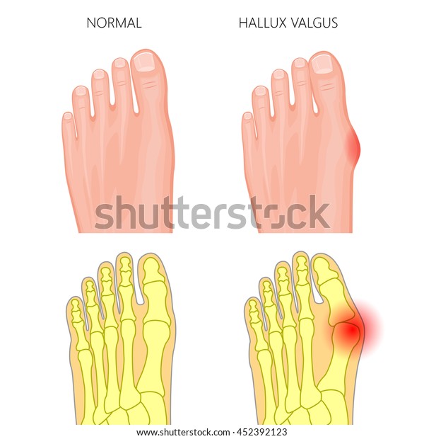 Vector Illustration Normal Foot Hallux Valgus Stock Vector (Royalty ...