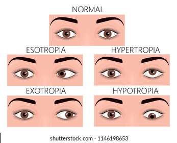 Vector illustration of normal human eyes and eyes with problem. Strabismus or crossed eyes types - esotropia, exotropia, hypertropia, hypotropia. For advertisement and medical publications. EPS 10.