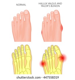 Vector Illustration of the normal human foot, valgus deviation of the first toe  and tailor's bunion. External and skeletal views.  Used: gradient, transparency, Blend mode.