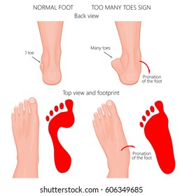 Vector illustration of the normal human foot and the foot with pronation or flatfoot, with hindfoot deformity. Too many toes sign.