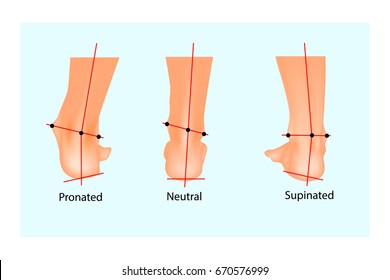 Ilustração vetorial do pé humano normal e do pé com pronação e supinação. Biomecânica do pé. Ortopedia.