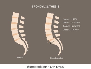 Vector illustration of normal lumbar spine and slipped vertebra or spondylolithesis. Degree of slipped vertebra.