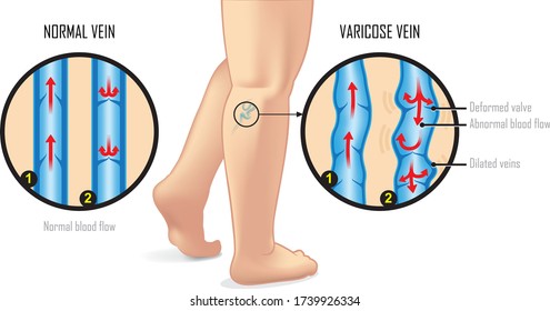 Vector Illustration Of Normal Vein And Varicose Vein Anatomy