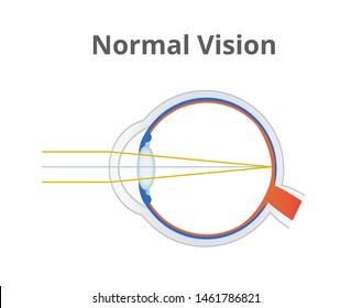 Myopia Hyperopia Normal Vision Common Vision Stock Vector (Royalty Free ...