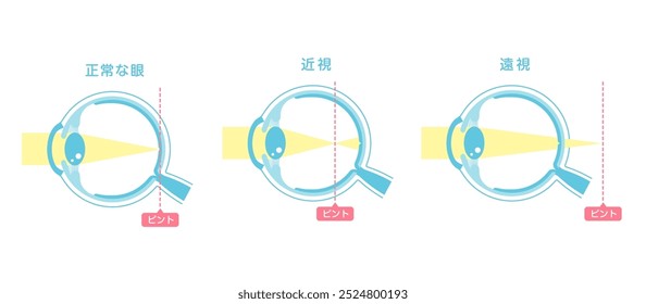 Vector illustration of normal vision and myopia and hyperopia. Translation: Normal eye, Myopia, Hyperopia, Focus.