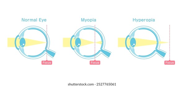 Ilustração vetorial de visão normal e miopia e hiperopia.