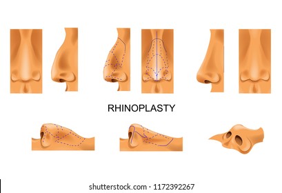 vector illustration of the nose. rhinoplasty. plastic surgery