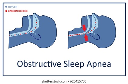 Vector Illustration Of Obstructive Sleep Apnea.