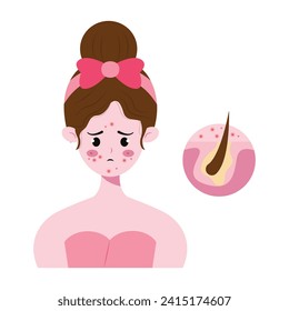 vector illustration of oily and acne prone skin problems