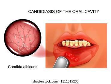 vector illustration of oral candidiasis. causative agent Candida albicans