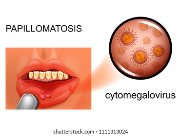 vector illustration of oral mucosal papillomatosis. cytomegalovirus