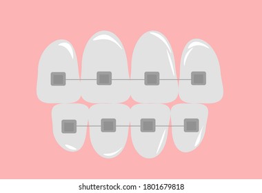 vector illustration orthodontic braces complex orthodontic fixed structures (devices) for correcting the position of human teeth in cases of malocclusion and unevenness of the dentition on an isolated