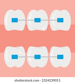 Vector illustration of orthodontics, correction of the posture of the teeth.