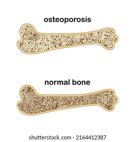 vector illustration of osteoporosis and normal bone on white background