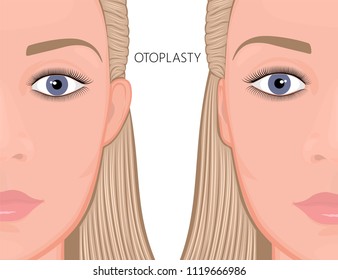 Vector illustration. Otoplasty before and after correction of protruding ears. Close up view. For medicinal publications and advertising of plastic surgery, beauty cosmetic procedures. EPS 10.