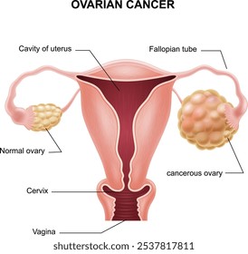 Ilustração vetorial da anatomia do câncer de ovário