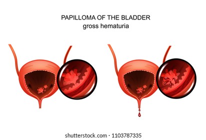 vector illustration of a papilloma in the urinary bladder