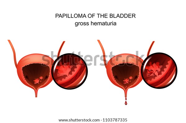 bladder papilloma reasons