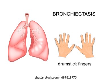 ilustración vectorial de la bronquiectasis pulmonar de un paciente. dedos como palos de tambor