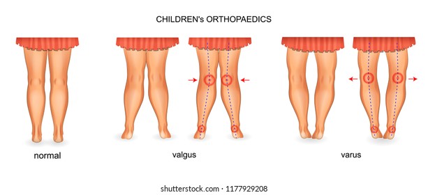 Vector Illustration Of Pediatric Orthopedics. Valgus And Varus