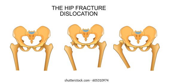 Vector Illustration Of A Pelvis, Hip Fracture. Hip Dislocation
