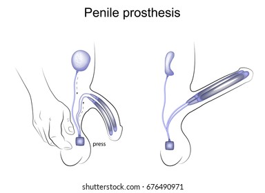 Vector Illustration Of A Penile Prosthesis. Urology
