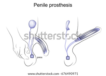 vector illustration of a penile prosthesis. urology
