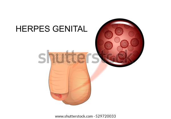 pénisz fertőző