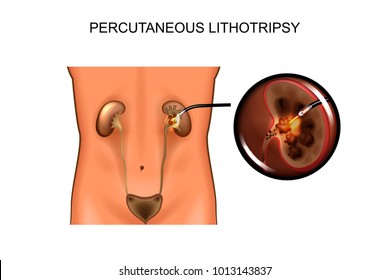 vector illustration of percutaneous laser lithotripsy. urology