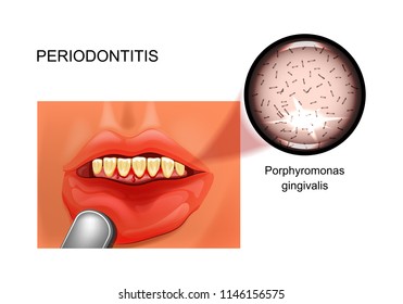 vector illustration of periodontitis. bleeding gums. stomatology