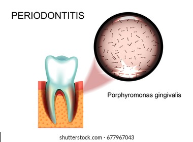 vector illustration of periodontitis. Porphyromonas gingivalis. stomatology.