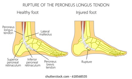 Vector illustration of Peroneal Tendon Injuries. Rupture of the peroneus longus tendon. Lateral ankle injury.