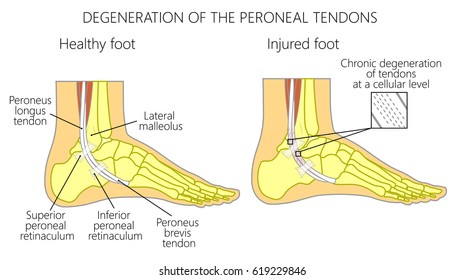 Vector Illustration Of Peroneal Tendon Injuries. Degeneration Of The Peroneus Longus And Brevis Tendons. Tendinosis Or Tendinopathy. Lateral Ankle Injury.